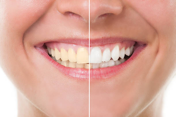 Understanding Teeth Discoloration